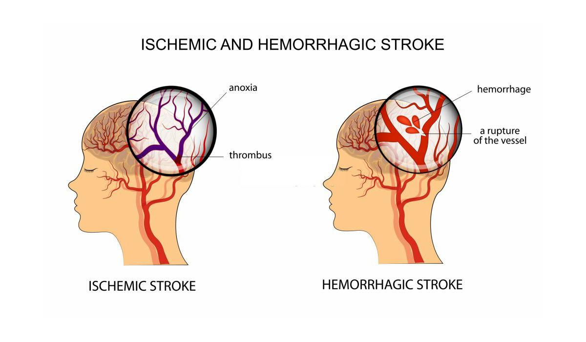 Stroke Recovery Through Ayurveda: Best Hospital & Therapies in Kerala