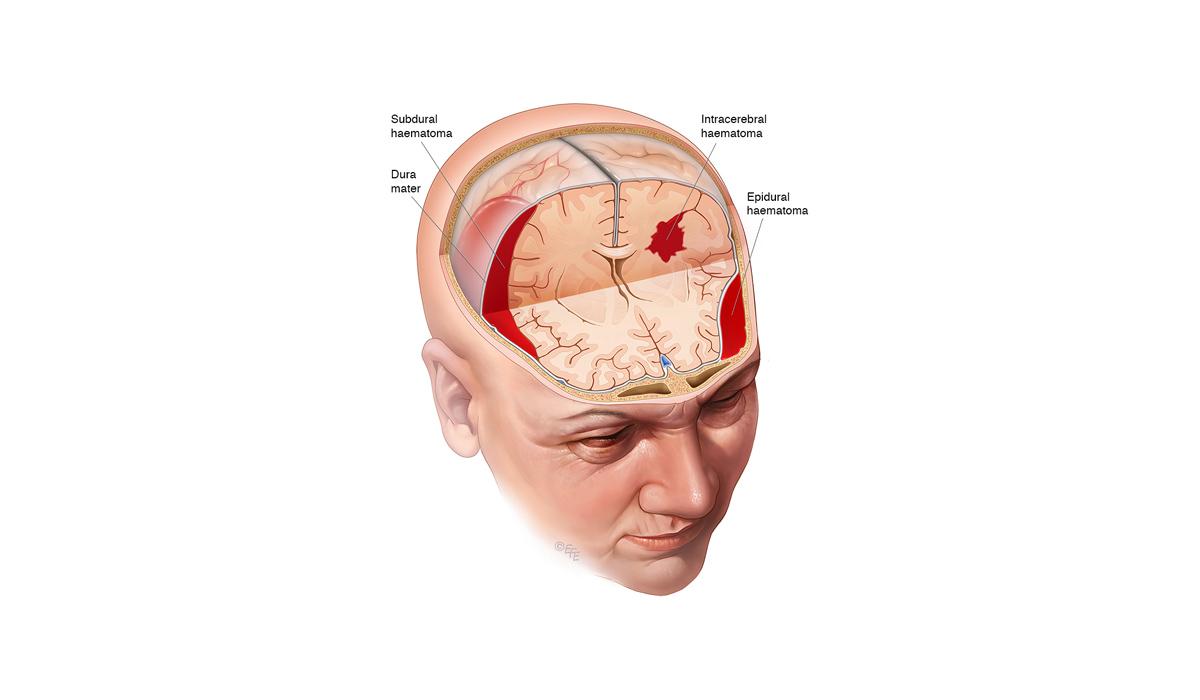 Ayurvedic Approach to Brain Injury Recovery at Milife Medicity, Kottakkal